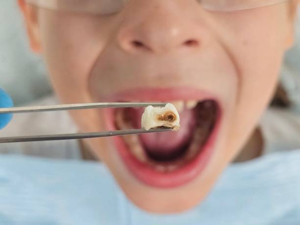 Best Emergency Wisdom Teeth Removal in Coleytown, CT